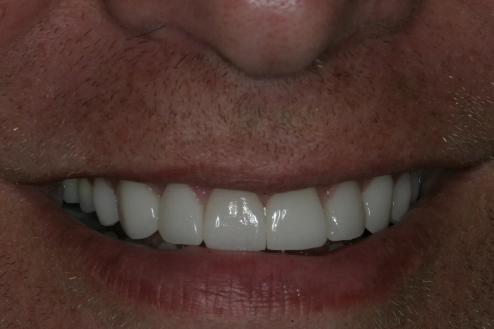 Smile gallery case 1 — after treatment