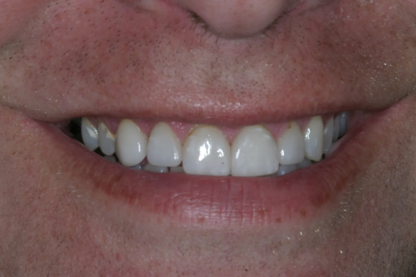 Smile gallery case 1 — before treatment