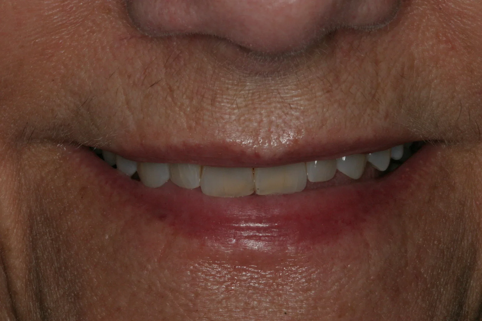 Smile gallery case 2 — before treatment