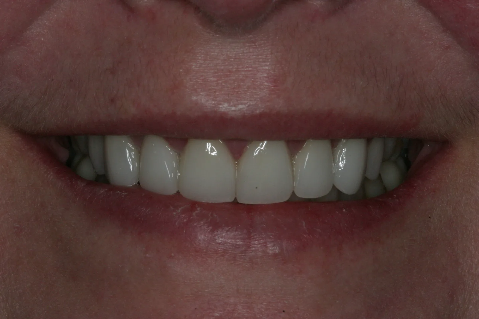 Smile gallery case 3 — after treatment