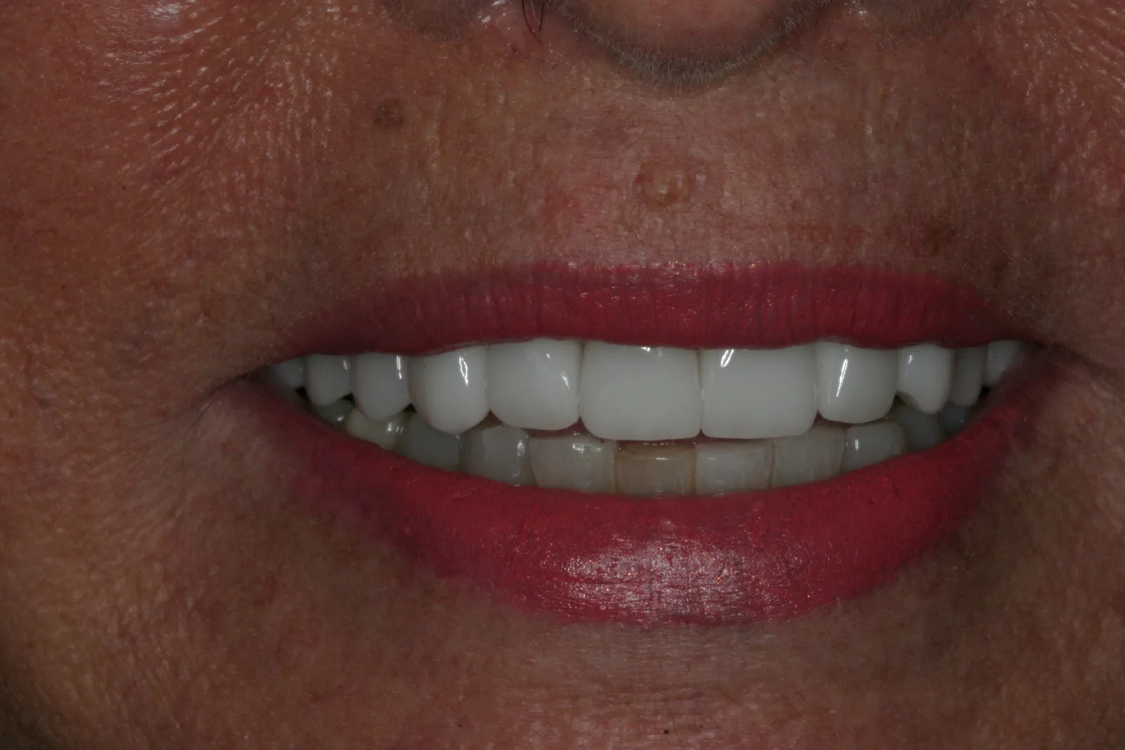 Smile gallery case 4 — after treatment