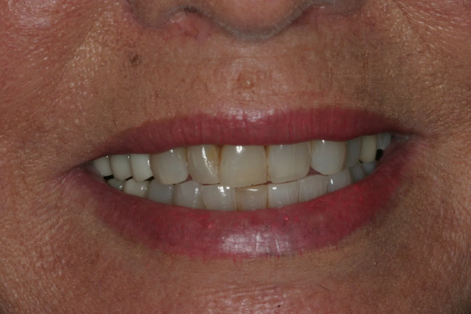 Smile gallery case 4 — before treatment