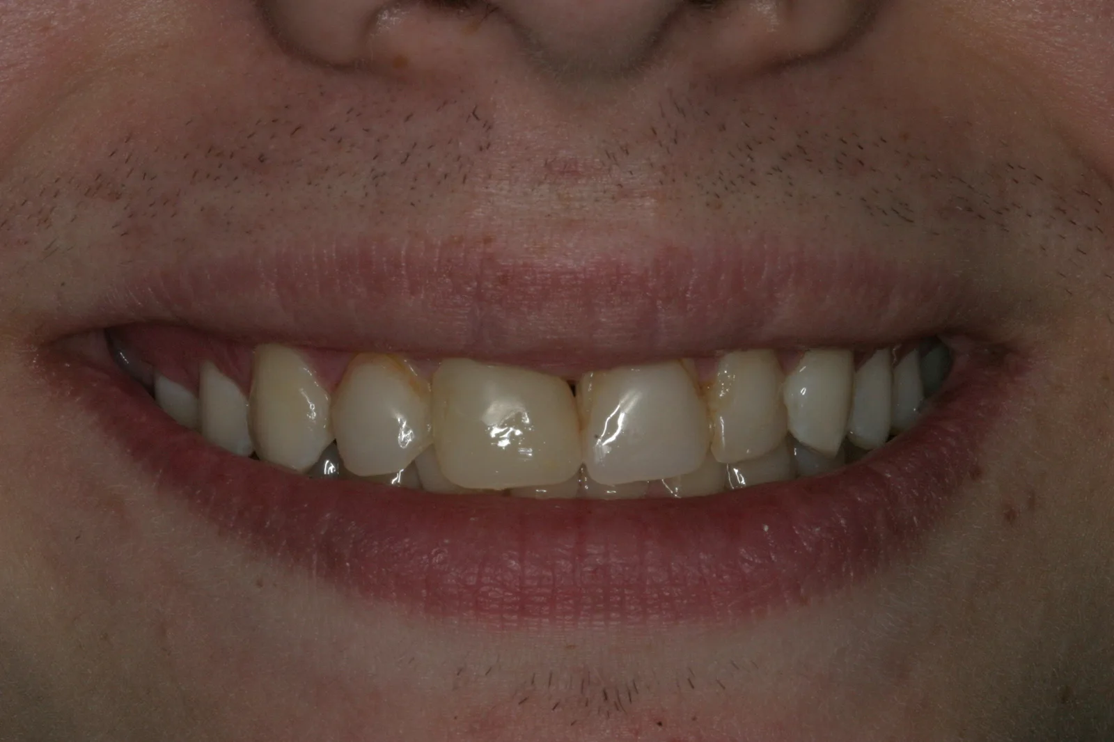 Smile gallery case 5 — before treatment