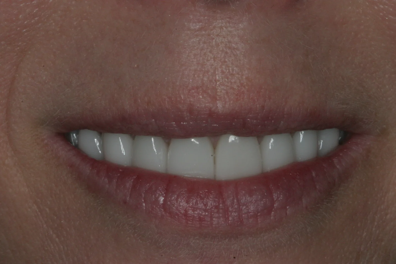 Smile gallery case 6 — after treatment