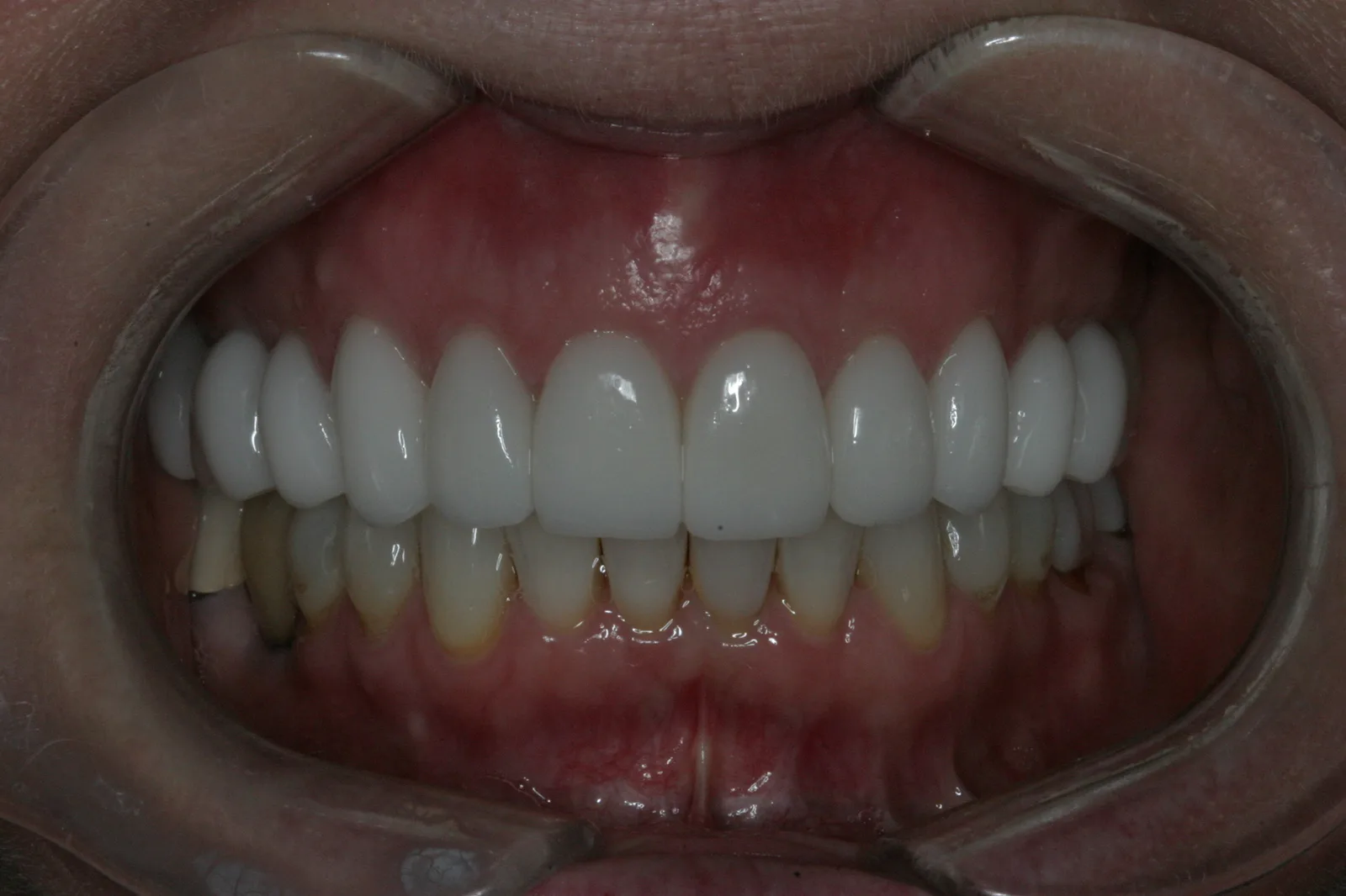 Smile gallery case 6, second example — after treatment