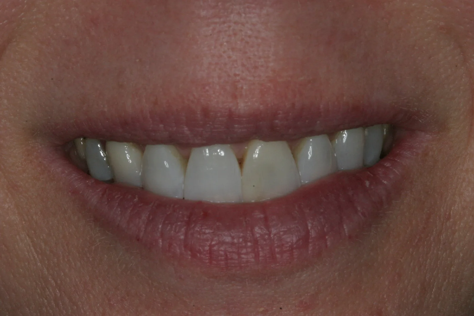 Smile gallery case 6 — before treatment