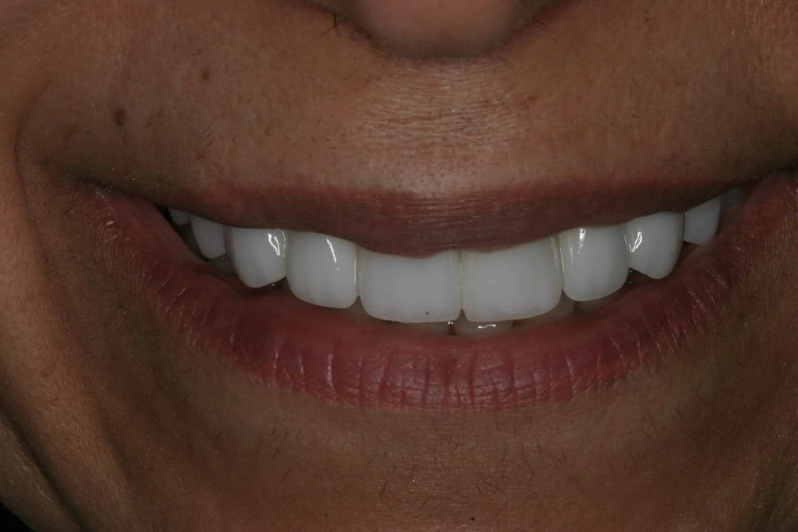Smile gallery case 7 — after treatment
