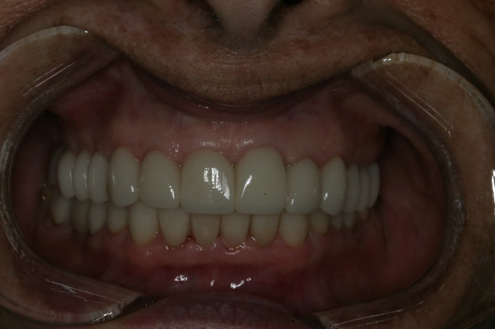 Smile gallery case 8 — after treatment