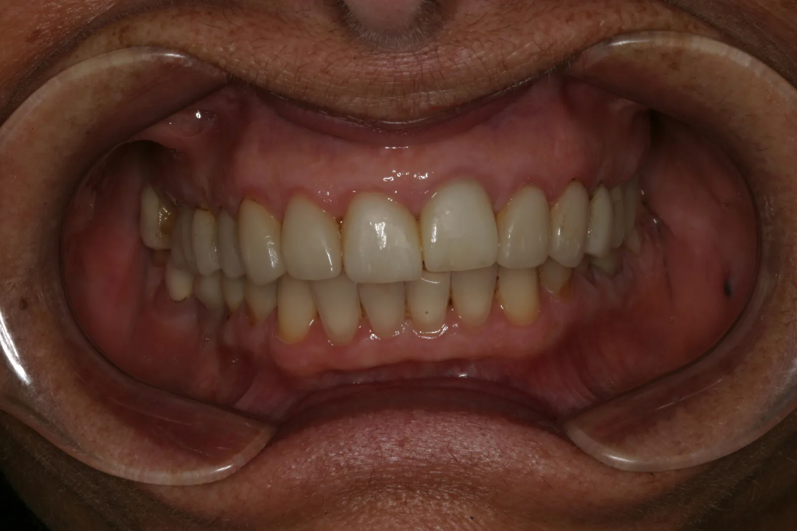Smile gallery case 8 — before treatment