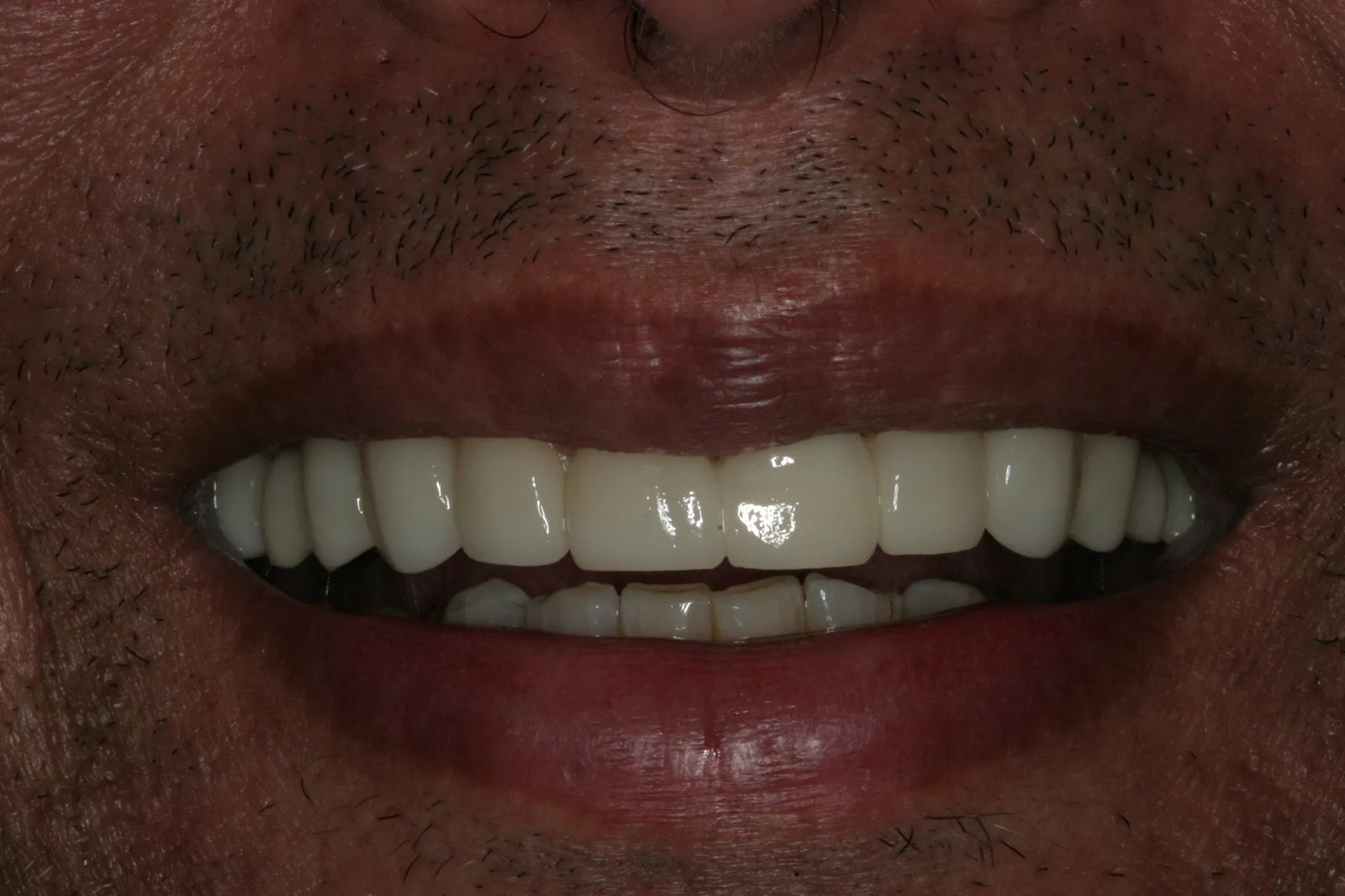 Smile gallery case 9 — after treatment
