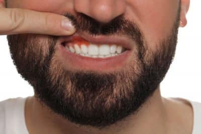 up close image of man with inflamed gums