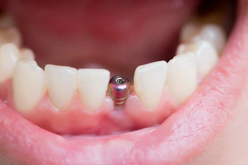 closeup of a dental implant