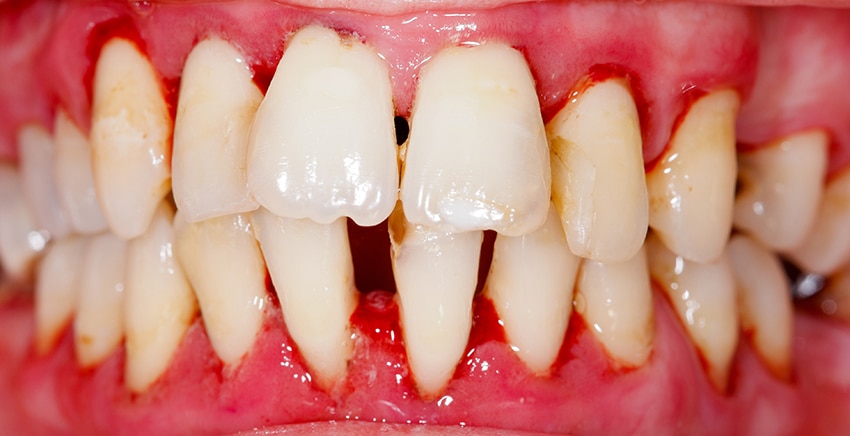 Close up of gum disease