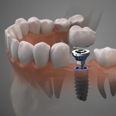 CT guided dental implants