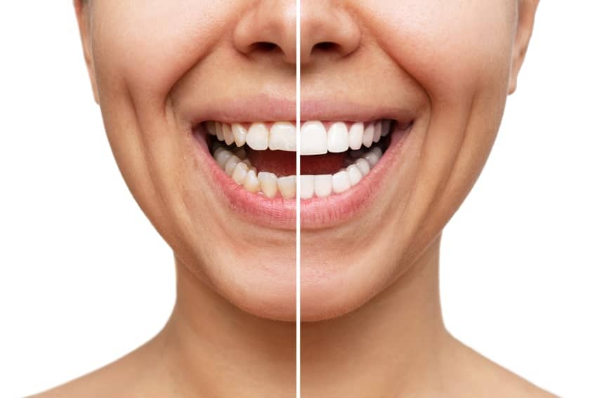 side by side comparison with and without veneers