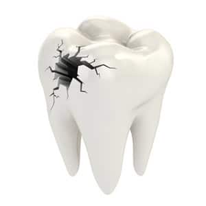 fix cracks in teeth, dental bonding, los gatos, san jose, campbell, saratoga, cupertino, santa clara, 
